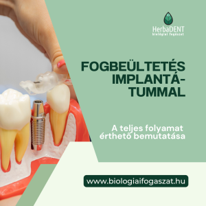 fogbeültetés implantátummal