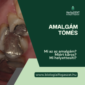 amalgám tömés